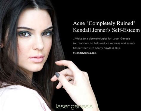 Laser Genesis Treatments For Redness Pore Size Acne And More Cascades