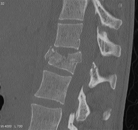 Thoracolumbar Burst Fracture Bone And Spine