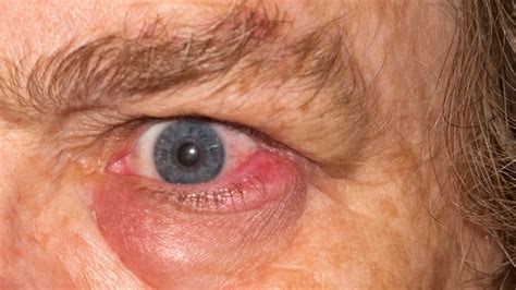Swollen Eyelids Causes Symptoms Treatment Options