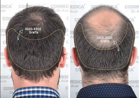 Crown Hair Transplants Cosmedica