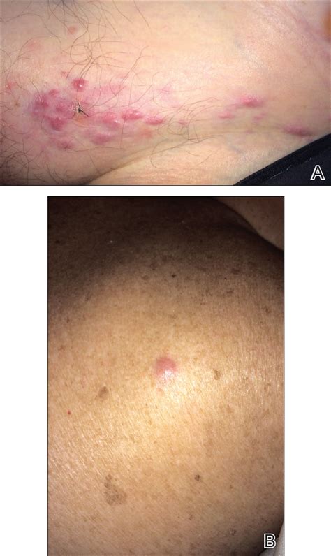 Mar 09, 2017 · merkel cell carcinoma (mcc) is a rare, aggressive skin cancer. Aggressive Merkel Cell Carcinoma in a Liver Transplant ...