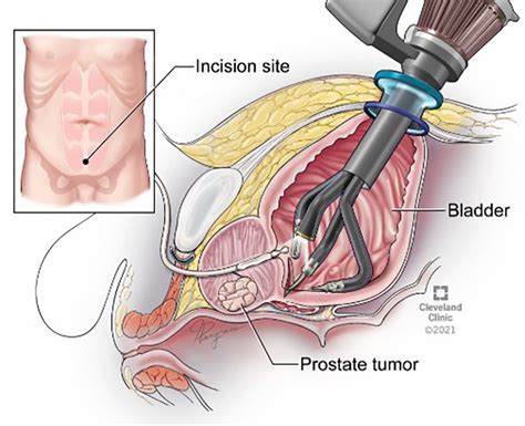Robotic Radical Prostatectomy In Patients With A Hostile Surgical Abdomen Consult Qd
