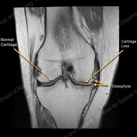 Hss Osteoarthritis Center Of Excellence Diagnosing Oa