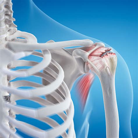 Anatomy Of Shoulder Rotator Cuff Tear Shoulder Pain Stock Photo