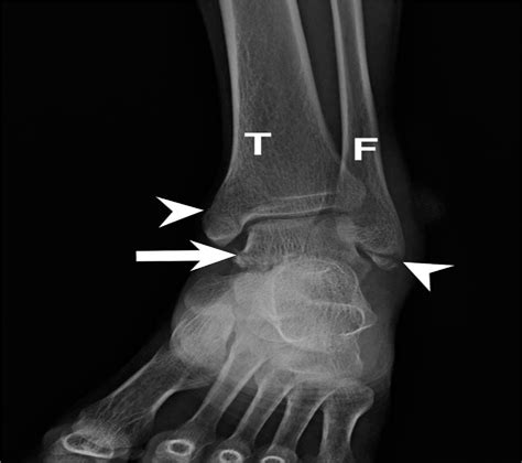 A Combination Of Bimalleolar Fracture And Fracture On Talar Medicine