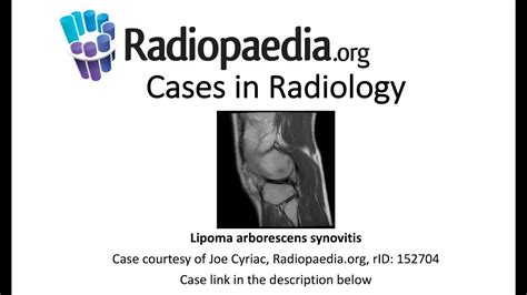 Lipoma Arborescens Synovitis Cases In Radiology Youtube