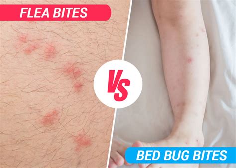 Flea Bed Bug Bites Difference