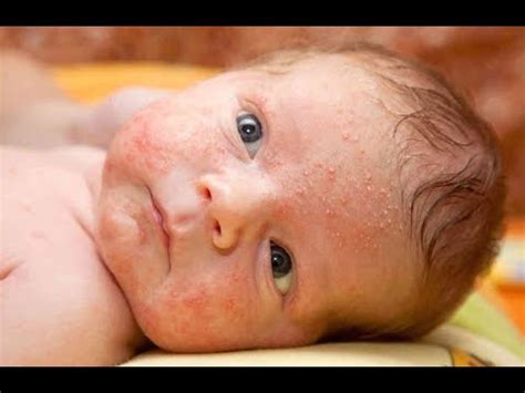 How to Get Rid of Baby Acne | How to treat baby acne 
