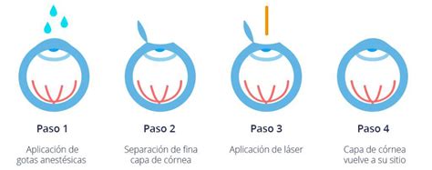 Cirugía Lasik Cuál es el tiempo de cicatrización de la córnea Oftalmólogos Martinez de