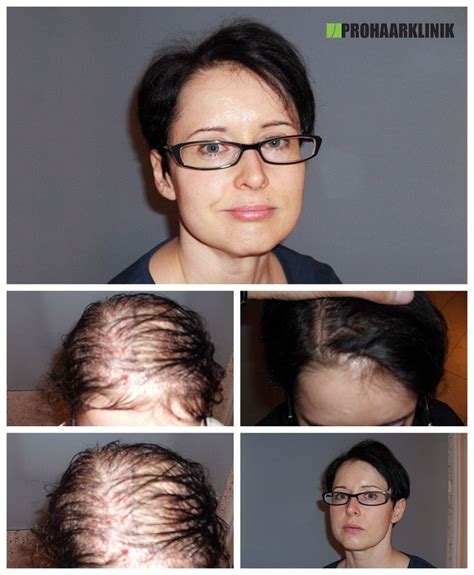 Alle infos auf einen blick! Haartransplantation Vorher Nachher Bilder der ...