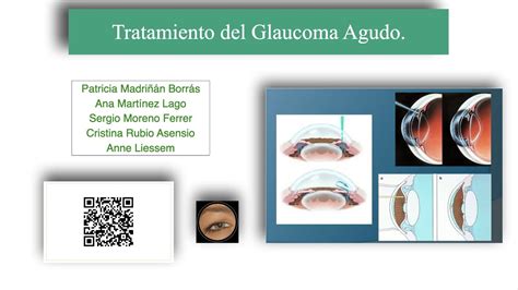 Tratamiento Del Glaucoma Agudo Youtube