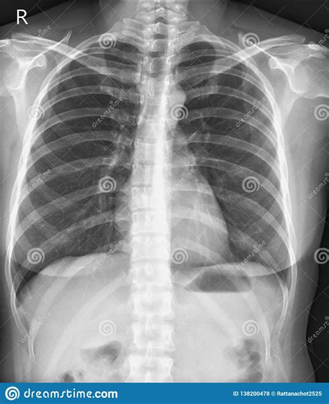 Chest X Ray Normalmedical Concept Stock Illustration