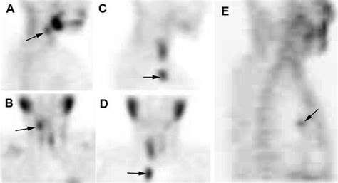 711 Examples Of Ectopic Parathyroid Adenomas A And B P4 Derived