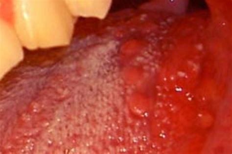 The 10 Best Images About Bumps On Tongue On Pinterest On Back