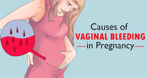 What Causes A Woman To Bleed During Pregnancy Pregnancywalls
