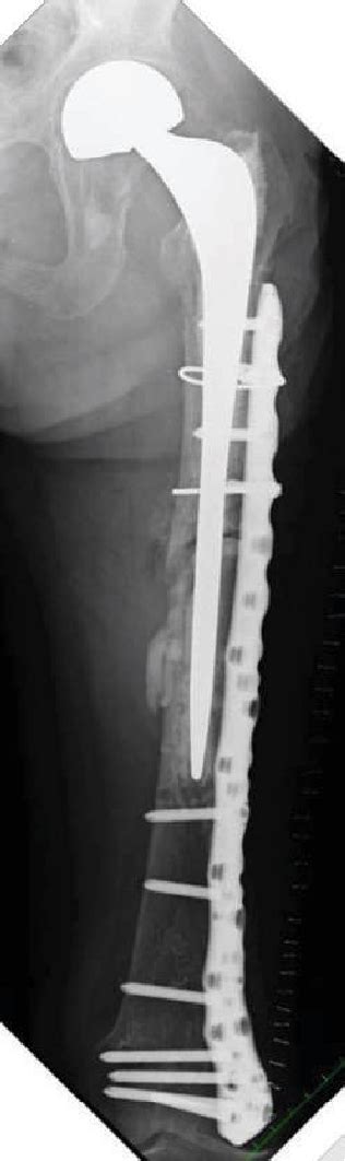 Figure From A Periprosthetic Femoral Fracture With Characteristics Of