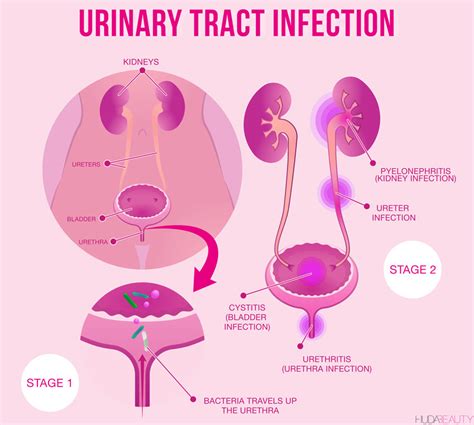 URINARY TRACT INFECTION UTI PACK
