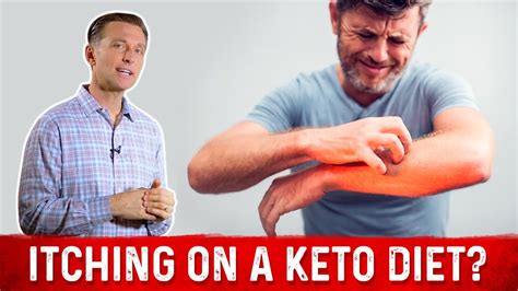 Are You Itching On A Ketogenic Diet Drberg On Keto Rash Youtube