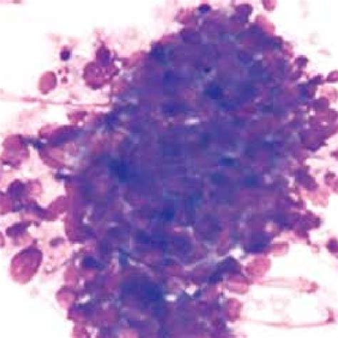 Cytology Smear Showing Metastatic Clusters Of Adenocarcinoma Giemsa Download Scientific