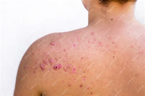 Premium Photo Occipital Acne In A Teenage Boy Healed Scars From