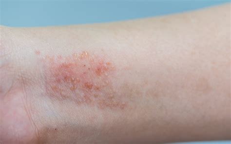 Dermatitis What Is It And Different Types With Photos