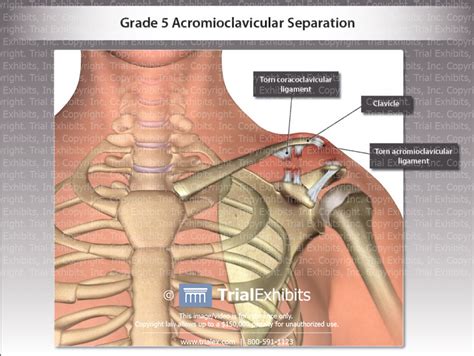 Grade 5 Acromioclavicular Separation Trialexhibits Inc