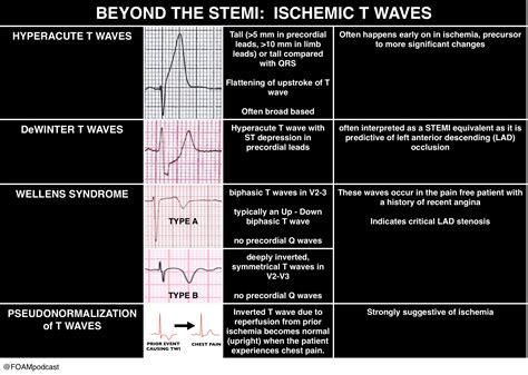 Patterns Of Ischemia T Waves On Ecg However There Grepmed