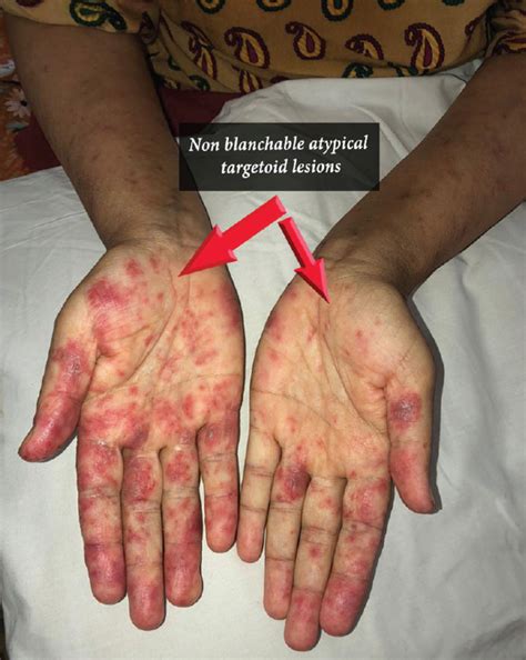 Generalized Acute Cutaneous Lupus Erythematosus In A Young Female