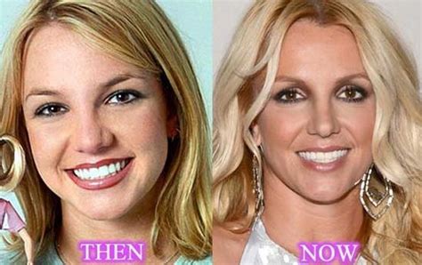 Britney Spears Before And After Plastic Surgery Azra Magazin