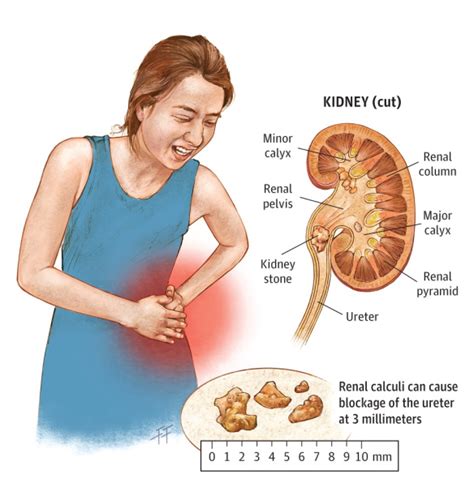 A Nutshell Review On The Therapeutics Of Renal Calculi