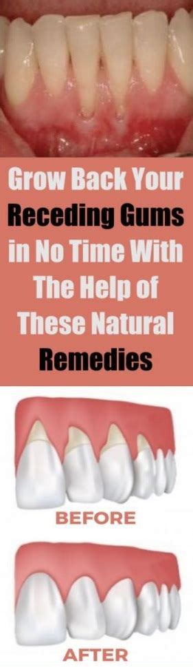 Daily Health Advisor Grow Back Your Receding Gums In No Time With The