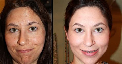 Chemical Peel Before And After