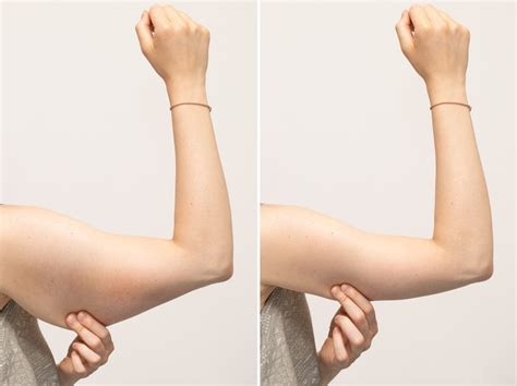 Brachioplasty Arm Lift Kelamis Plastic Surgery