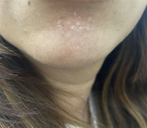I35f Have Developed These Small Bumps On My Chin More In Comments