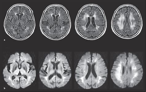 Figure 1 From Serial Assessments Of Delayed Encephalopathy After Carbon