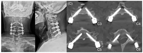 Jcm Free Full Text Medial Pedicle Pivot Point Using Preoperative Computed Tomography