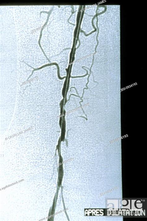 Arterial Angioplasty Result Angiogram Of Stenosis Of The Femoral