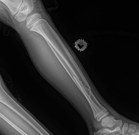 Closed Fracture Of Left Distal Tibia In A Young Boy Uni Clinic