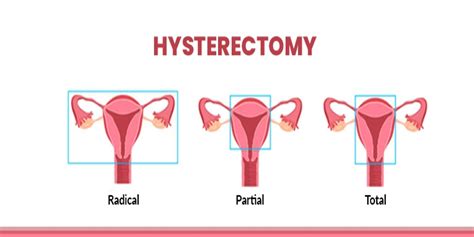 hysterectomy surgery