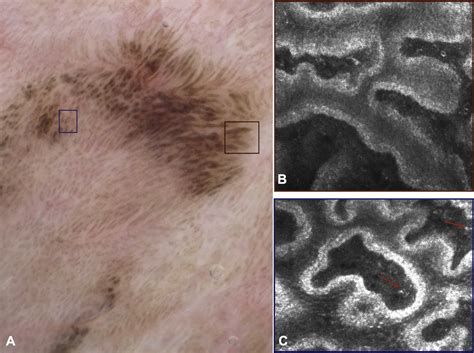 Dermoscopic And Confocal Microscopy Patterns Of Vulvar Mucosal