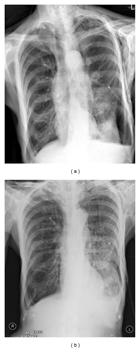 Reexpansion Pulmonary Edema Repe Is A Rare Complication Occurring
