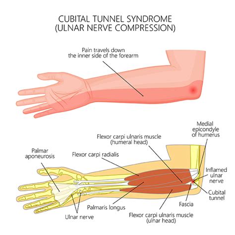Treatment Of Cubital Tunnel Syndrome Health And Care