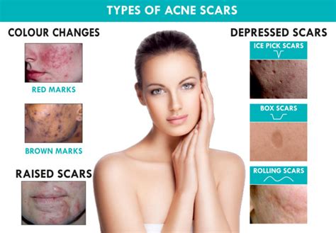 Dr Ameesha Mahajan Acne Scars