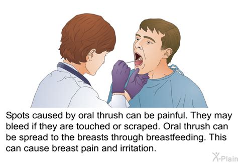 PatEdu Com Oral Thrush