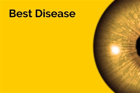 Best Disease Isightcornwall