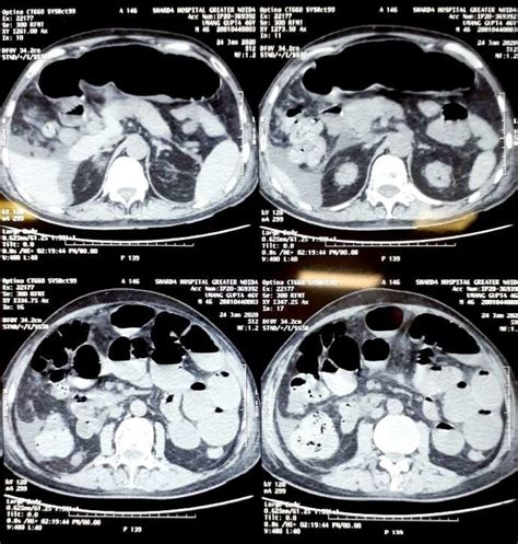 Ct Abdomen Showing Distended Small Bowel And Ascites Download