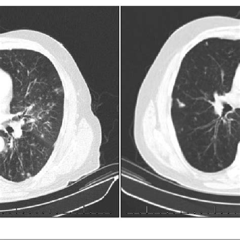 Left Ct Chest On Presentation Note The Diffuse Poorly Defined Nodules