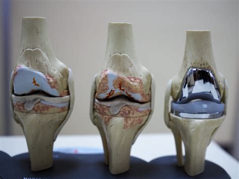 What Is The Artificial Knee Joint Bangkok Advanced Clinics