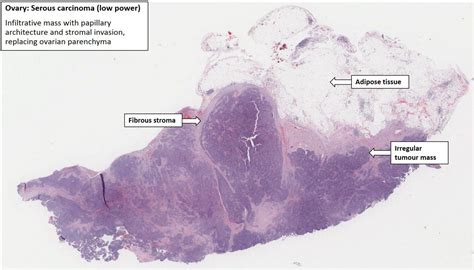 Ovary Serous Carcinoma Serous Cystadenocarcinoma Nus Pathweb