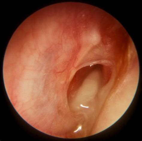 Inner Ear Infection Symptoms Causes Treatment Pictures Hubpages